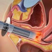 ostetriciaeginecologia it 3-it-310598-the-beneficial-effects-of-fractional-co2-laser-treatment-on-perineal-changes-during-puerperium-n2 042