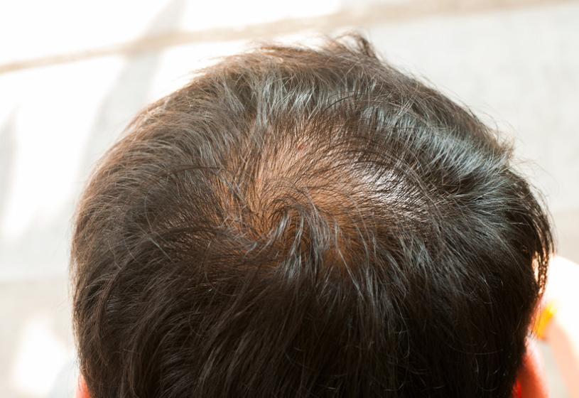 Leggero diradamento dei capelli: attenzione ai 5 segnali