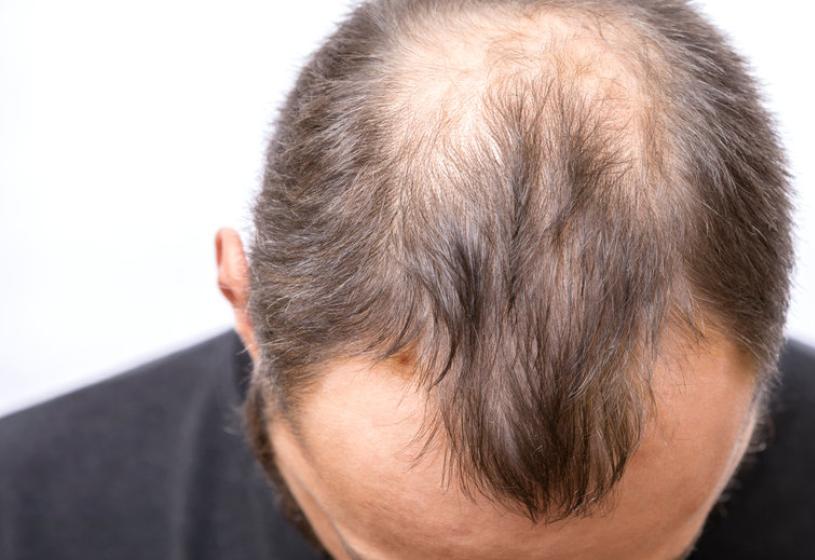 Alopecia da stress: come si guarisce in modo naturale