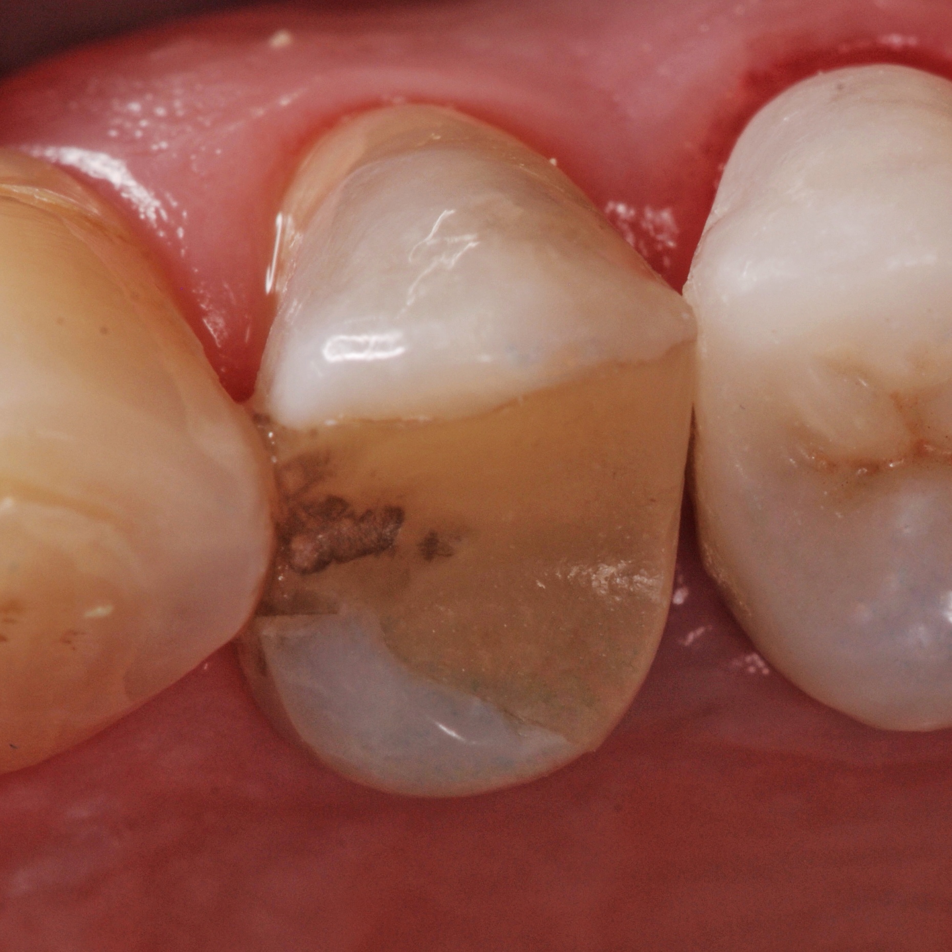 dentista-riccione-marcobartolini it intarsio-onlay-su-premolare-superiore 001