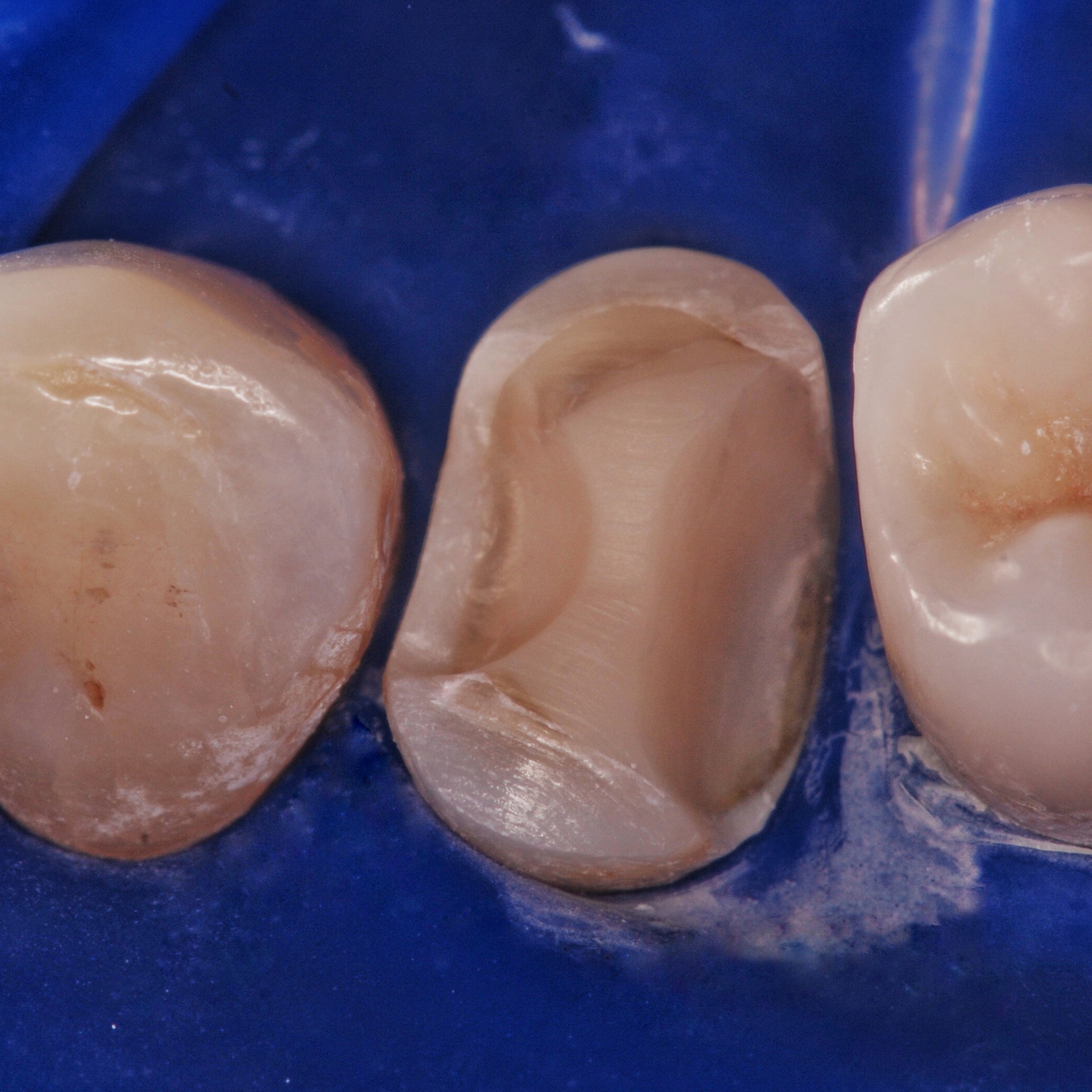 dentista-riccione-marcobartolini it intarsio-onlay-su-premolare-superiore 002